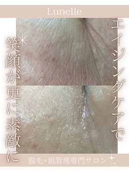 ルネル(Lunelle)/若いからって油断してない??