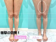 小顔専門カンナムビューティー 麻布十番店【ララピール/ハーブピーリング/小顔/痩身】/オンダリフト/麻布十番／六本木