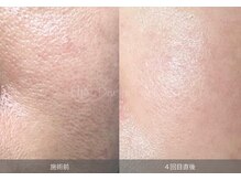オンド(OND)の雰囲気（くすみ 肌荒れ 毛穴悩み 肌の不安定な方攻めずに土台からケアを）