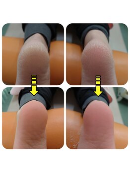 どうはく堂 西勝山接骨院の写真/足元のケアは間に合っていますか？角質ケアならお任せを♪乾燥しがちなかかとのケアもお任せください☆