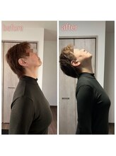 ビボディ(B-body)/首痛before after