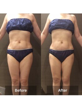 アランチャンティック(AlamCantik)/インドエステ施術事例