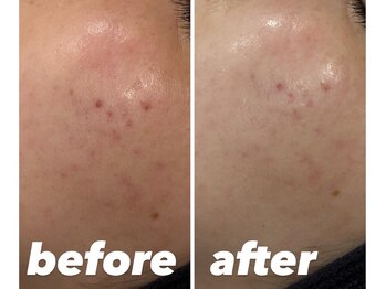 クラスペディア 嘉島店/毛穴洗浄/高濃度炭酸ケア