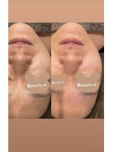 ギャラクシービューティー(galaxy beauty)/リフトアップ