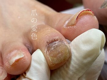 爪の変色