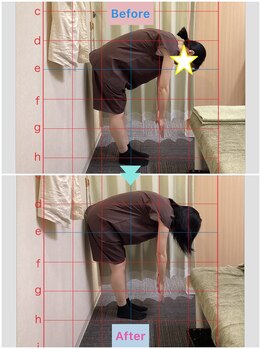 鍼灸 整体院 ひわたし/◇腰の痛みで曲げられない！