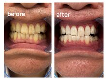 コナホワイトニング 神保町/ホワイトニング