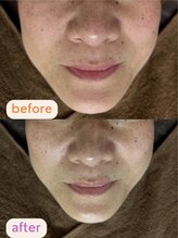 サクラ(SAKURA)/小顔矯正で若々しい表情に♪