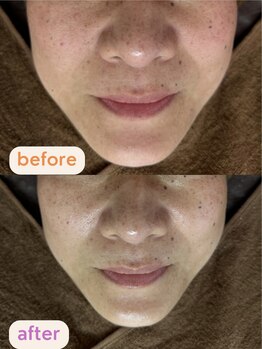 サクラ(SAKURA)/小顔矯正で若々しい表情に♪