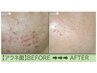 脂性肌■ザラベタ角質肥厚・凸凹改善【剥離なしハーブ＆毛穴洗浄】70分¥7900
