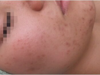 ビューティーメイクさくら/ポツポツ肌改善