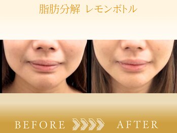 エステ ド フルール(Esthe de Fleur)/レモンボトルのBefore/After