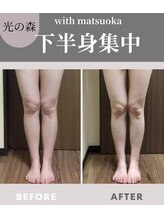 ウィズマツオカ 光の森店/エルフィーノ痩身(12回)効果写真