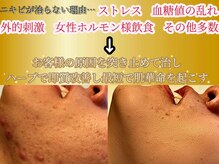 骨髄幹細胞等を使用した鎮静トリートメント肌を休息させる◎