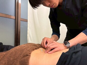 リ ムーヴ鍼灸整体院 大宮駅前院/鍼灸施術