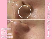 エンクリニカルラボ 三宮店(E&N CLINICAL LABO)/ハイドラアクアピール