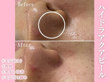 エンクリニカルラボ 三宮店(E&N CLINICAL LABO)/ハイドラアクアピール