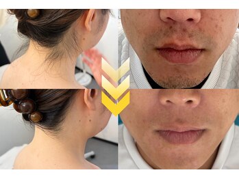 グランヴィール(GRANVIR)の写真/【美肌特化の顔脱毛】痛みに配慮した産毛ケアで化粧ノリ劇的UP♪肌悩みをケアしながら透明感あふれる素肌☆