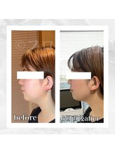 フローフシ∞/【小顔】20代女性症例写真