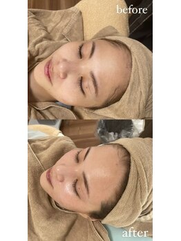 ミーミドットアイ(Mi-mi.i)/顔ダニ産毛除去で肌質改善☆