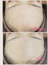 ビューティー アディクト(Beauty addict)/フェイシャルWax♪