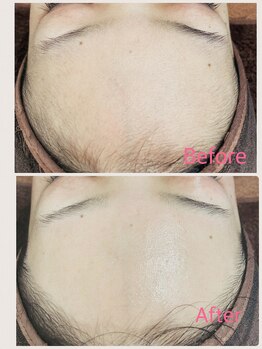 ビューティー アディクト(Beauty addict)/フェイシャルWax♪