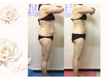 スマイルデイズ(Smiledays)/痩身上半身