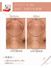 ミーカラー(mecalla.)/ララピールBA