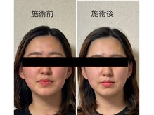 美心鍼/ビフォーアフター