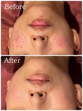 エステティック レイビス 青森店(RAYVIS)/どんなお肌悩みもお任せください