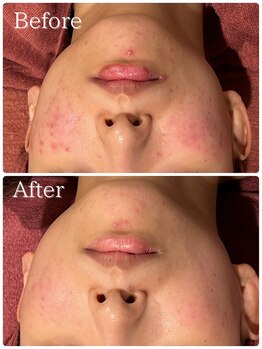 エステティック レイビス 青森店(RAYVIS)/どんなお肌悩みもお任せください