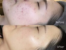 ミーラヤ(MILAYA)/梅田毛穴/梅田リアボーテ