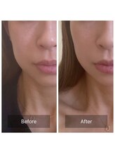 ニコリ(NICOLI)/フェイシャルビフォーアフター