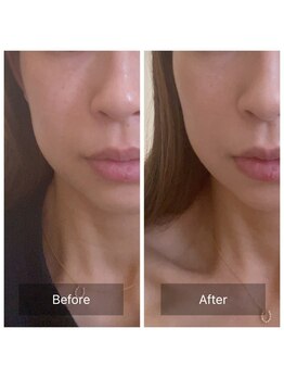 ニコリ(NICOLI)/フェイシャルビフォーアフター