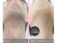 グリシーヌ(GLYCINE)/脱毛3回目の効果★