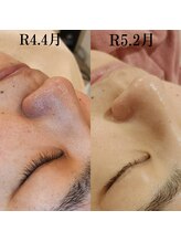 レイネイル レイエステティック 岐阜茜部店(RAY NAIL & RAY ESTHETIC)/継続の効果