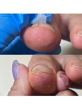 ウェルズユキ(well's yuki)/巻き爪（縦に爪が割れてくる）