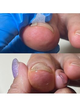 ウェルズユキ(well's yuki)/巻き爪(縦に爪が割れてくる)