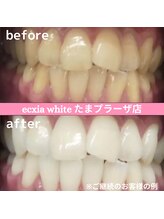エクシアホワイトニング たまプラーザ店/ビフォーアフター