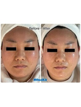 ホノカ(HOnoKA)/EMS+コラーゲン