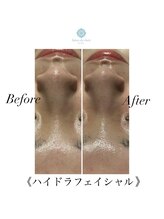 サロンドシェリ(salon de cheri)/毛穴洗浄