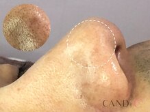 キャンディ 天王寺(CANDi)/ハイドラピーリング黒ずみ毛穴◎