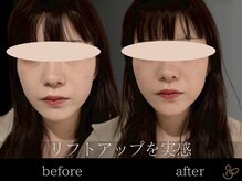 チョコバリ 恵比寿店(chocobari)/小顔リフトアップ（美容鍼）20代