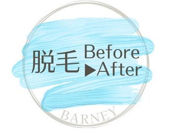 バーニー 梅田店(BARNEY)/脱毛施術Before after