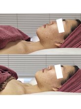 ラヴィ(La vie)/ハーブピーリング/ニキビケア