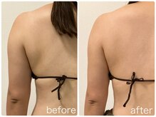 リリィブラン(Lily branc)/ブライダル/痩身/背中+二の腕