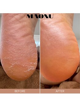 マオヌー(MAONU)/韓国式足裏角質ケア　症例写真