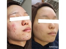 ビーピー 渋谷(b.p.)/ニキビケア