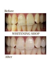 ホワイトニングショップ 府中店/ビフォーアフター