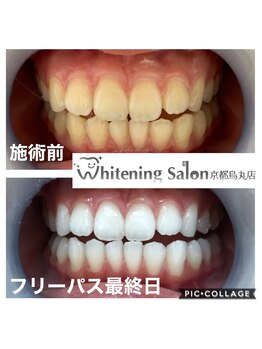 ホワイトニングサロン 京都烏丸店/ホワイトニング施術例